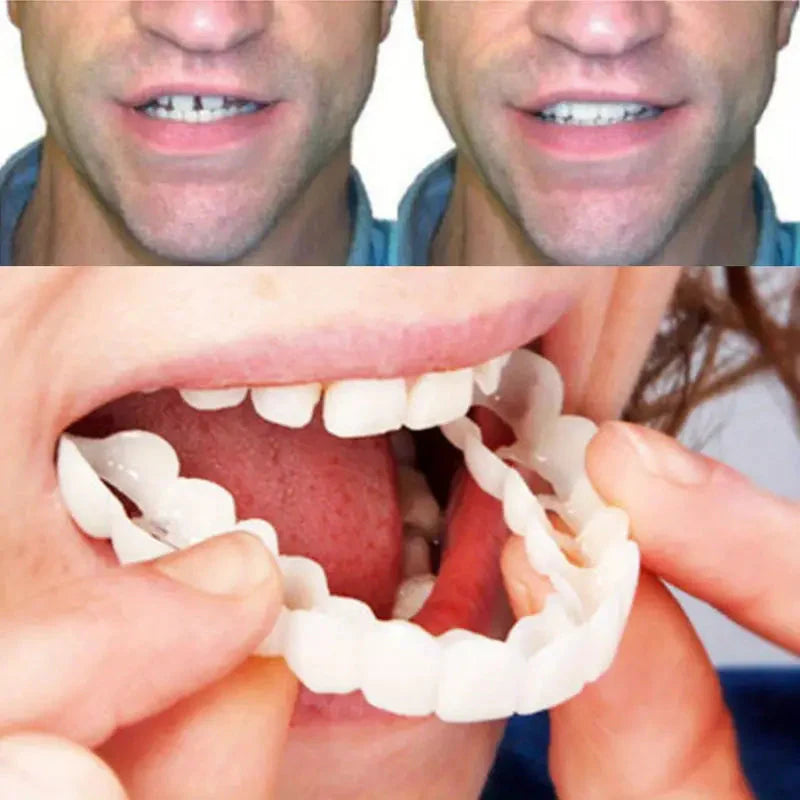 Snap on Smile Teeth Whitening veneers