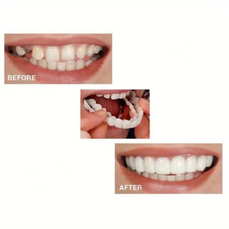 Snap on Smile Teeth Whitening veneers